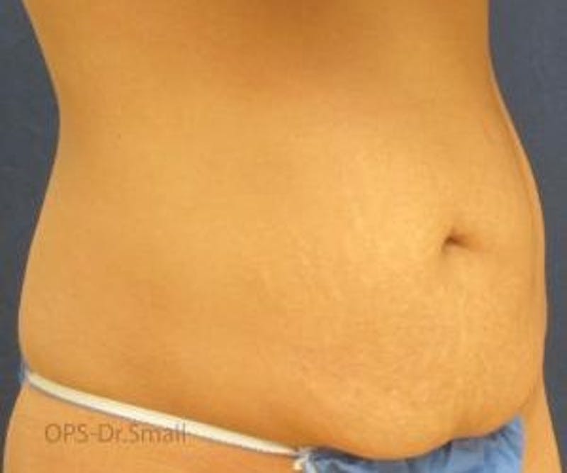 Abdominoplasty/Tummy Tuck Before & After Gallery - Patient 449533 - Image 3