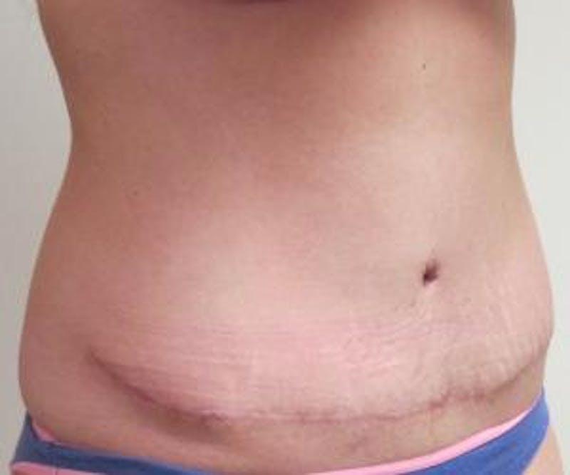 Abdominoplasty/Tummy Tuck Before & After Gallery - Patient 449533 - Image 4