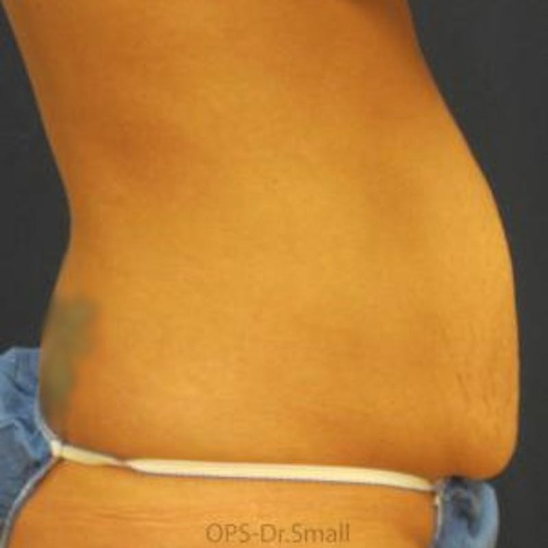 Abdominoplasty/Tummy Tuck Before & After Gallery - Patient 449533 - Image 5