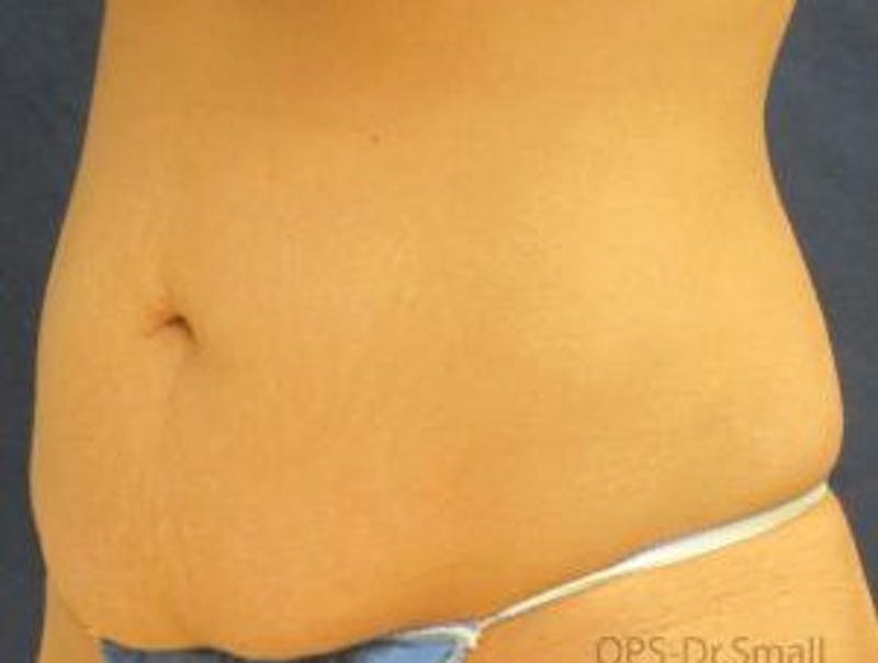 Abdominoplasty/Tummy Tuck Before & After Gallery - Patient 449533 - Image 7