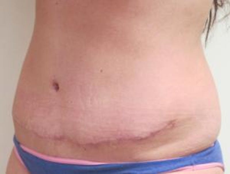 Abdominoplasty/Tummy Tuck Before & After Gallery - Patient 449533 - Image 8