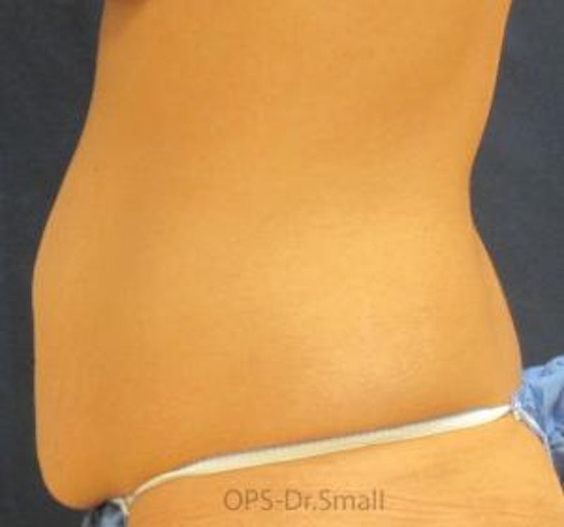 Abdominoplasty/Tummy Tuck Before & After Gallery - Patient 449533 - Image 9