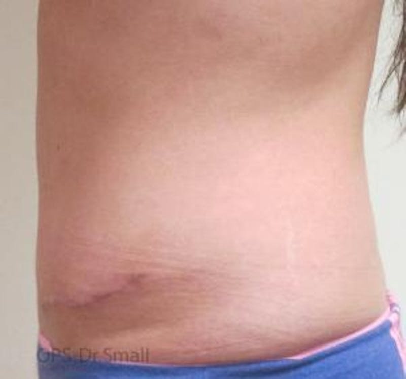 Abdominoplasty/Tummy Tuck Before & After Gallery - Patient 449533 - Image 10