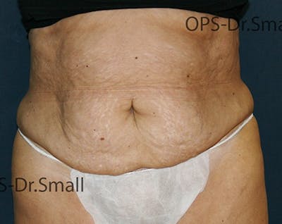 Abdominoplasty/Tummy Tuck Before & After Gallery - Patient 342710 - Image 1