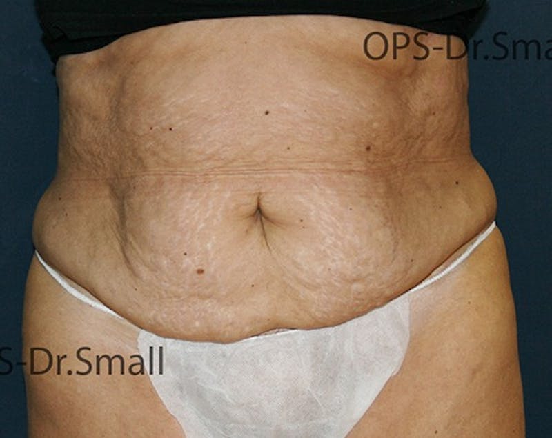 Abdominoplasty/Tummy Tuck Before & After Gallery - Patient 342710 - Image 1