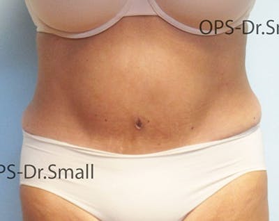 Abdominoplasty/Tummy Tuck Before & After Gallery - Patient 342710 - Image 2