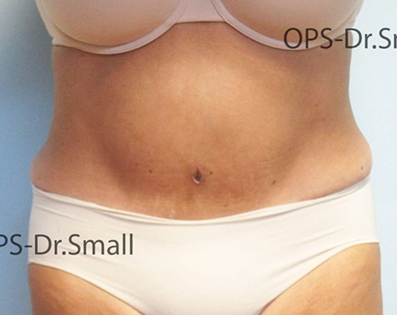 Abdominoplasty/Tummy Tuck Before & After Gallery - Patient 342710 - Image 2
