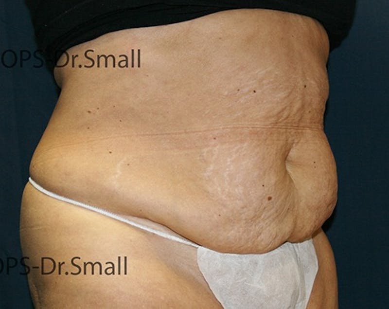 Abdominoplasty/Tummy Tuck Before & After Gallery - Patient 342710 - Image 3
