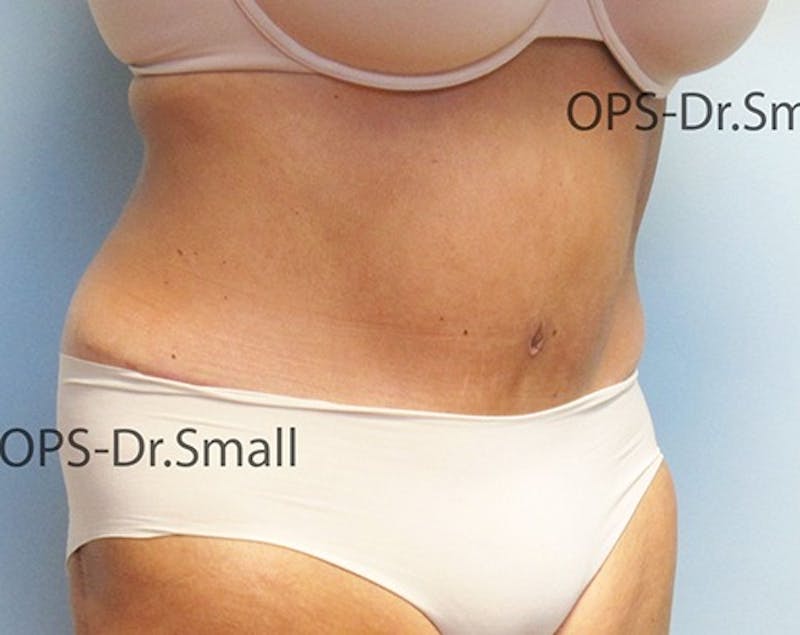 Abdominoplasty/Tummy Tuck Before & After Gallery - Patient 342710 - Image 4