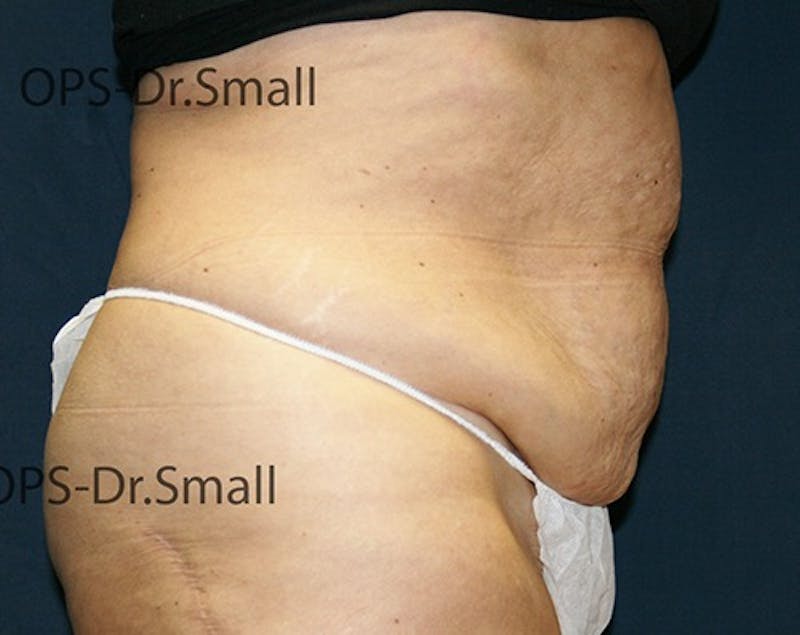 Abdominoplasty/Tummy Tuck Before & After Gallery - Patient 342710 - Image 5