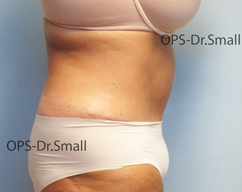 Abdominoplasty/Tummy Tuck Before & After Gallery - Patient 342710 - Image 6