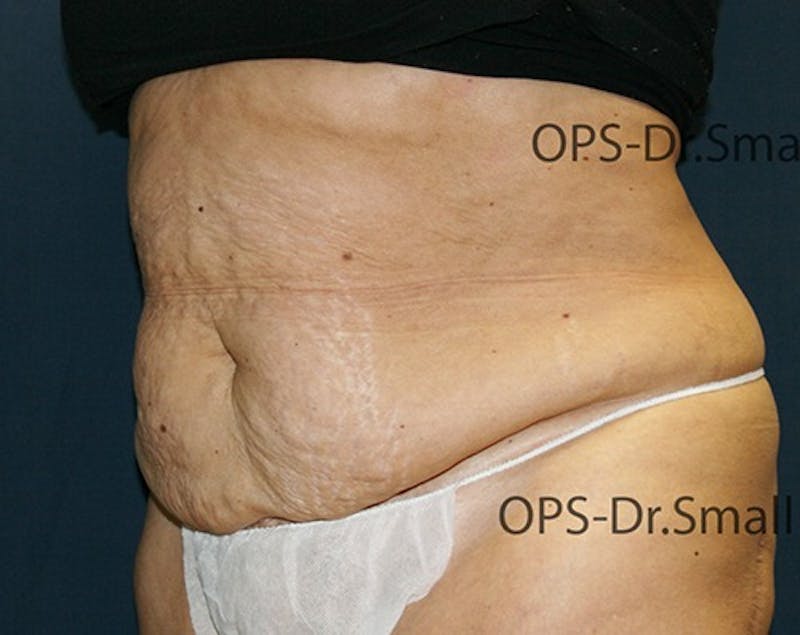 Abdominoplasty/Tummy Tuck Before & After Gallery - Patient 342710 - Image 7