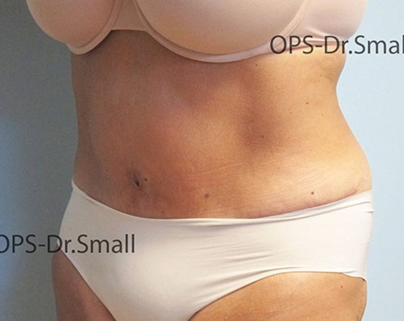 Abdominoplasty/Tummy Tuck Before & After Gallery - Patient 342710 - Image 8