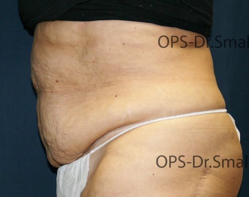 Abdominoplasty/Tummy Tuck Before & After Gallery - Patient 342710 - Image 9