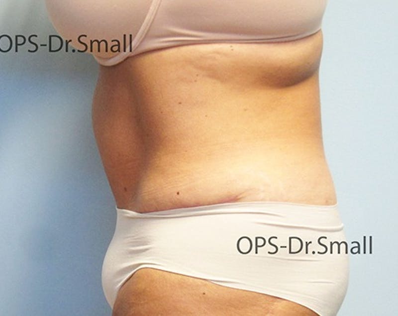 Abdominoplasty/Tummy Tuck Before & After Gallery - Patient 342710 - Image 10