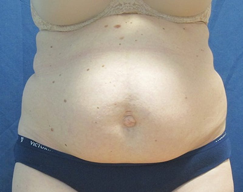 Abdominoplasty/Tummy Tuck Before & After Gallery - Patient 127411 - Image 1
