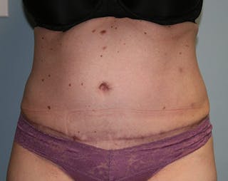 Abdominoplasty/Tummy Tuck Before & After Gallery - Patient 127411 - Image 2