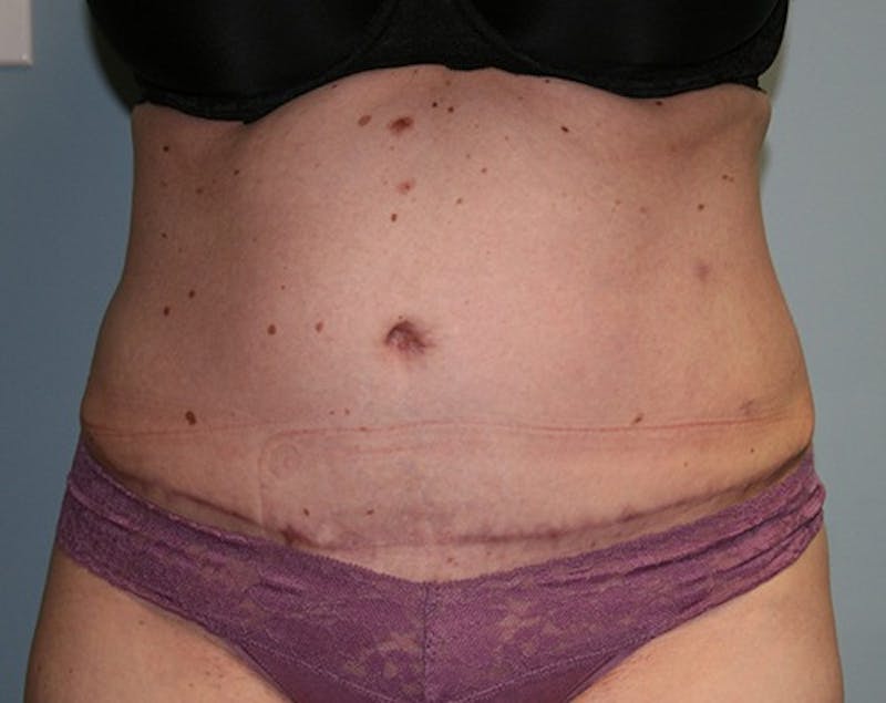 Abdominoplasty/Tummy Tuck Before & After Gallery - Patient 127411 - Image 2
