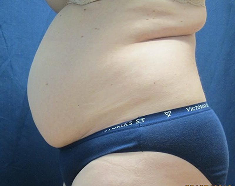 Abdominoplasty/Tummy Tuck Before & After Gallery - Patient 127411 - Image 3