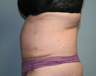 Abdominoplasty/Tummy Tuck Before & After Gallery - Patient 127411 - Image 4