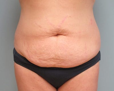 Abdominoplasty/Tummy Tuck Before & After Gallery - Patient 248788 - Image 1
