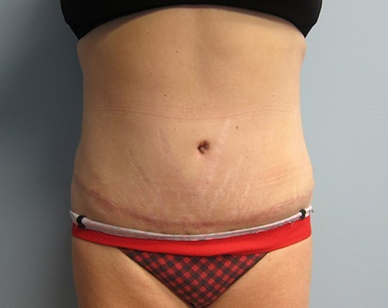 Abdominoplasty/Tummy Tuck Before & After Gallery - Patient 248788 - Image 2