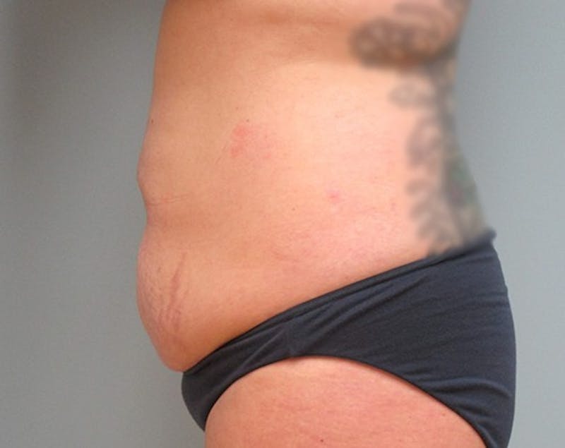 Abdominoplasty/Tummy Tuck Before & After Gallery - Patient 248788 - Image 3