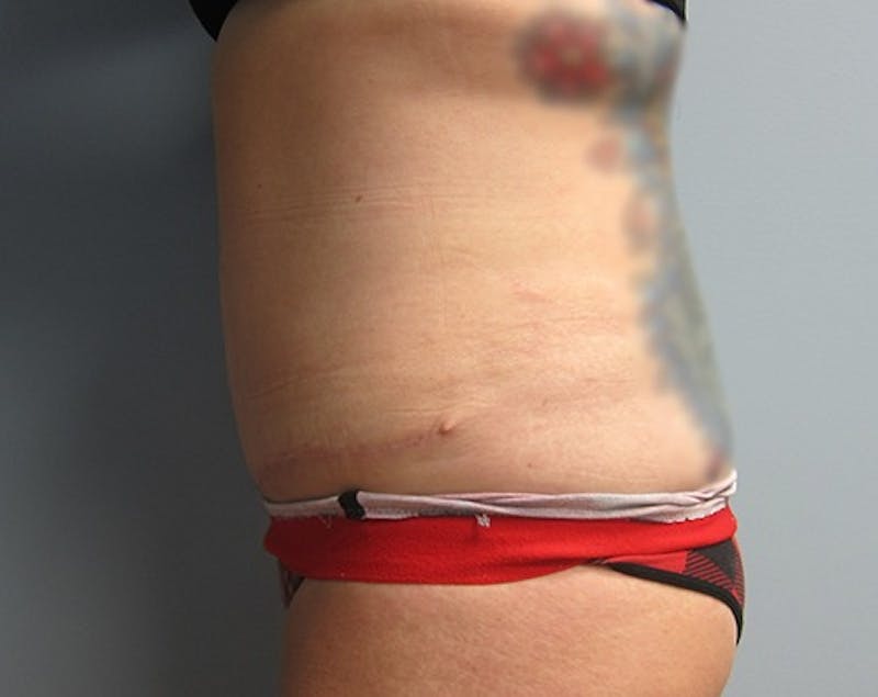 Abdominoplasty/Tummy Tuck Before & After Gallery - Patient 248788 - Image 4
