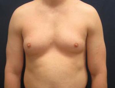 Gynecomastia Before & After Gallery - Patient 765445 - Image 1