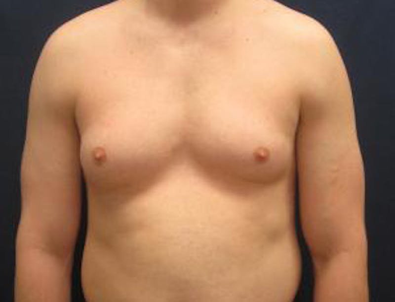 Gynecomastia Before & After Gallery - Patient 765445 - Image 1