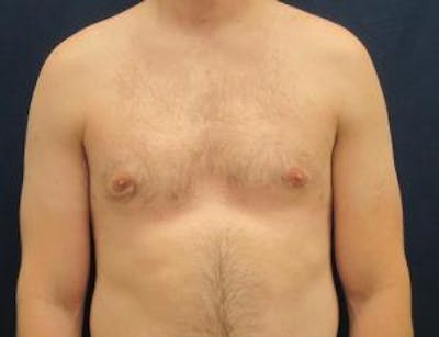 Gynecomastia Before & After Gallery - Patient 765445 - Image 2