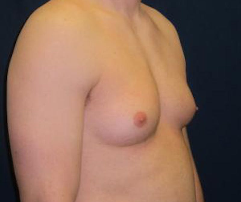 Gynecomastia Before & After Gallery - Patient 765445 - Image 3