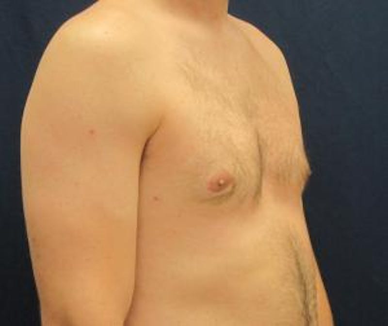 Gynecomastia Before & After Gallery - Patient 765445 - Image 4