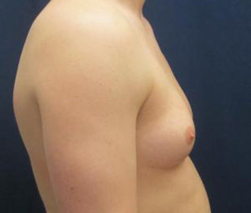 Gynecomastia Before & After Gallery - Patient 765445 - Image 5