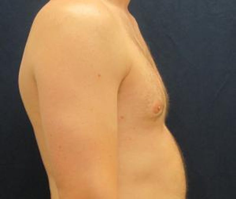 Gynecomastia Before & After Gallery - Patient 765445 - Image 6