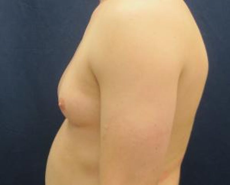 Gynecomastia Before & After Gallery - Patient 765445 - Image 7