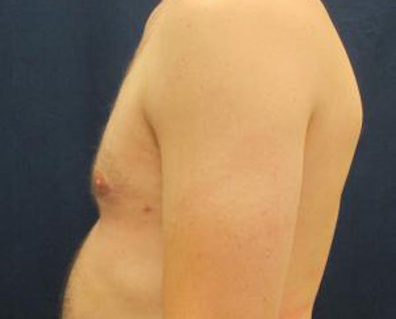Gynecomastia Before & After Gallery - Patient 765445 - Image 8
