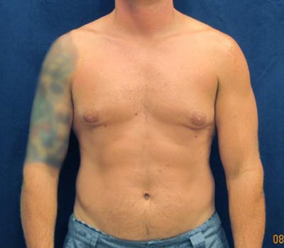 Gynecomastia Before & After Gallery - Patient 279618 - Image 1