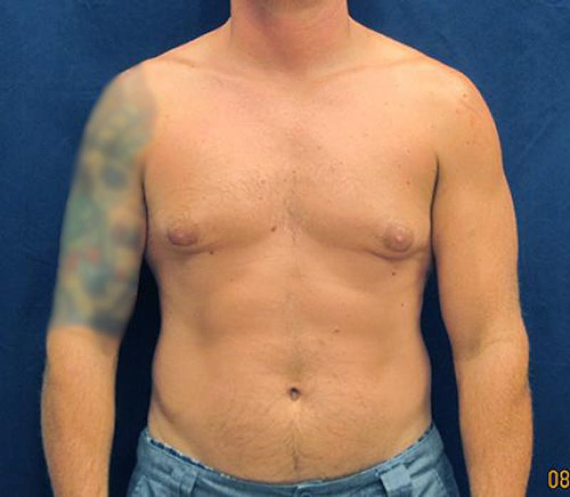 Gynecomastia Before & After Gallery - Patient 279618 - Image 1