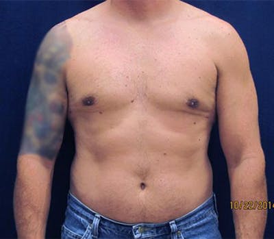 Gynecomastia Before & After Gallery - Patient 279618 - Image 2