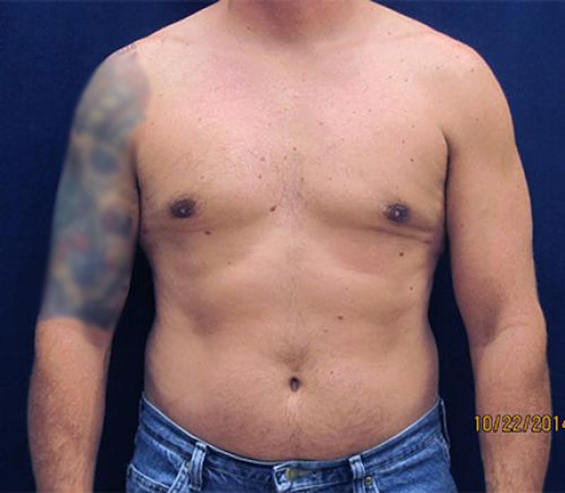 Gynecomastia Before & After Gallery - Patient 279618 - Image 2