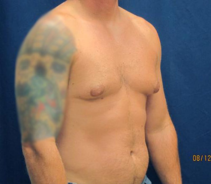 Gynecomastia Before & After Gallery - Patient 279618 - Image 3