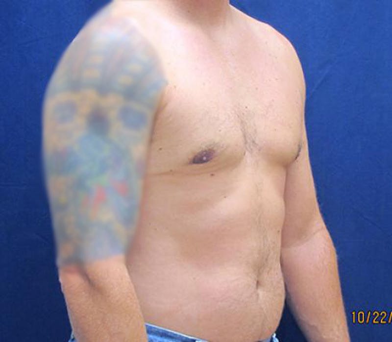 Gynecomastia Before & After Gallery - Patient 279618 - Image 4