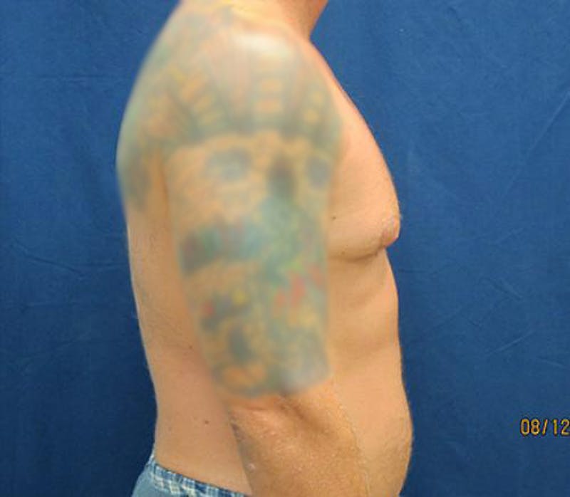 Gynecomastia Before & After Gallery - Patient 279618 - Image 5