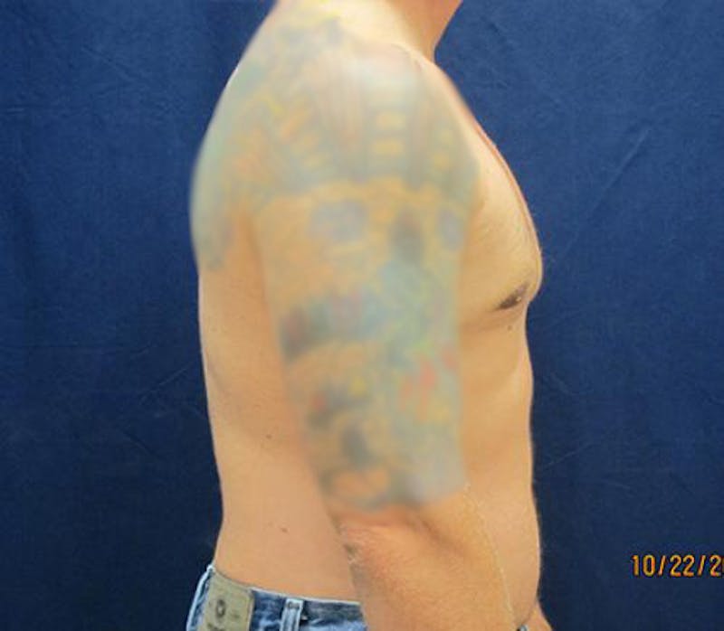 Gynecomastia Before & After Gallery - Patient 279618 - Image 6