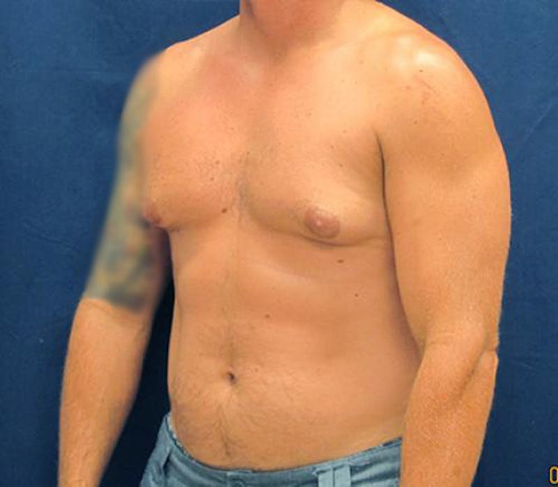 Gynecomastia Before & After Gallery - Patient 279618 - Image 7