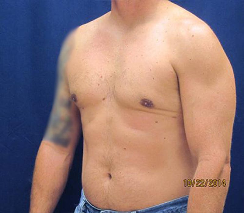 Gynecomastia Before & After Gallery - Patient 279618 - Image 8