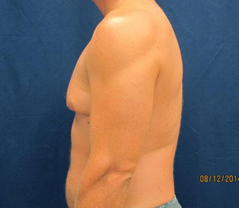 Gynecomastia Before & After Gallery - Patient 279618 - Image 9