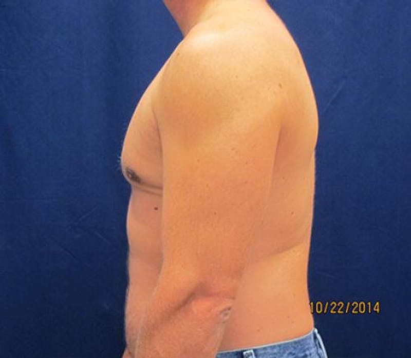 Gynecomastia Before & After Gallery - Patient 279618 - Image 10