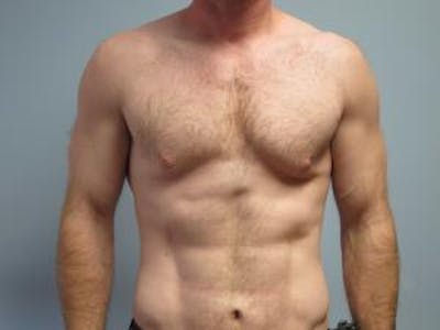 Gynecomastia Before & After Gallery - Patient 166148 - Image 1